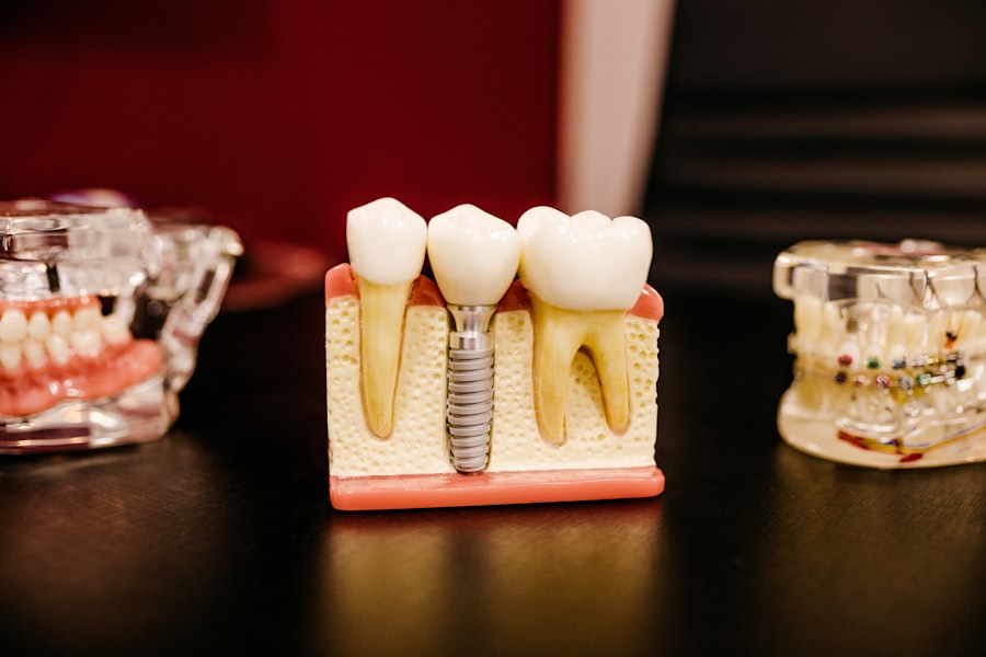 Modelo de implante dental